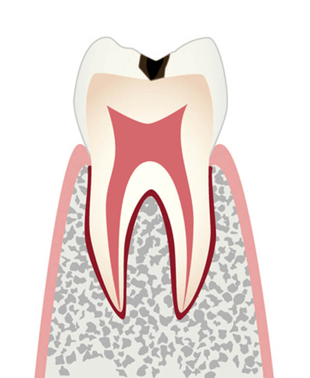 エナメル質に小さな穴が空いたむし歯