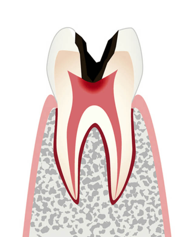 神経まで進行したむし歯