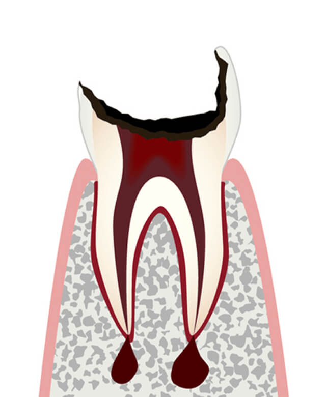 歯根まで進行したむし歯