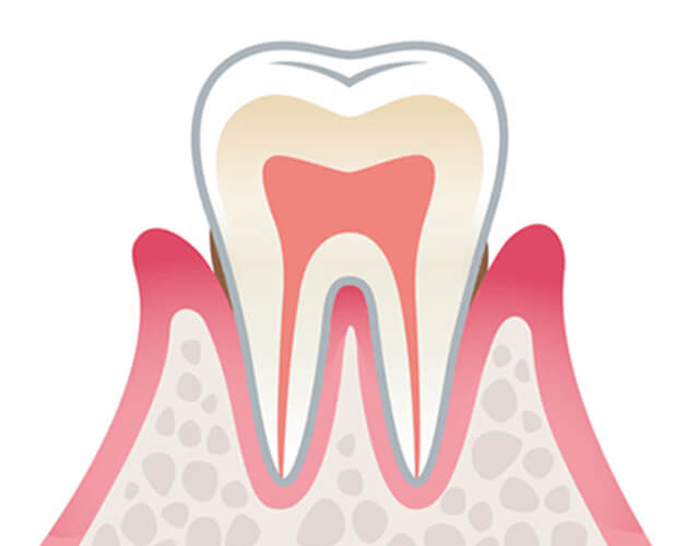 軽度歯周病